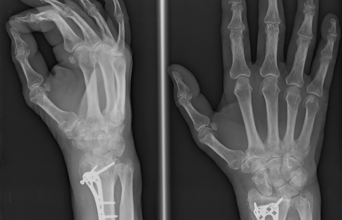 Digital Xray for hands